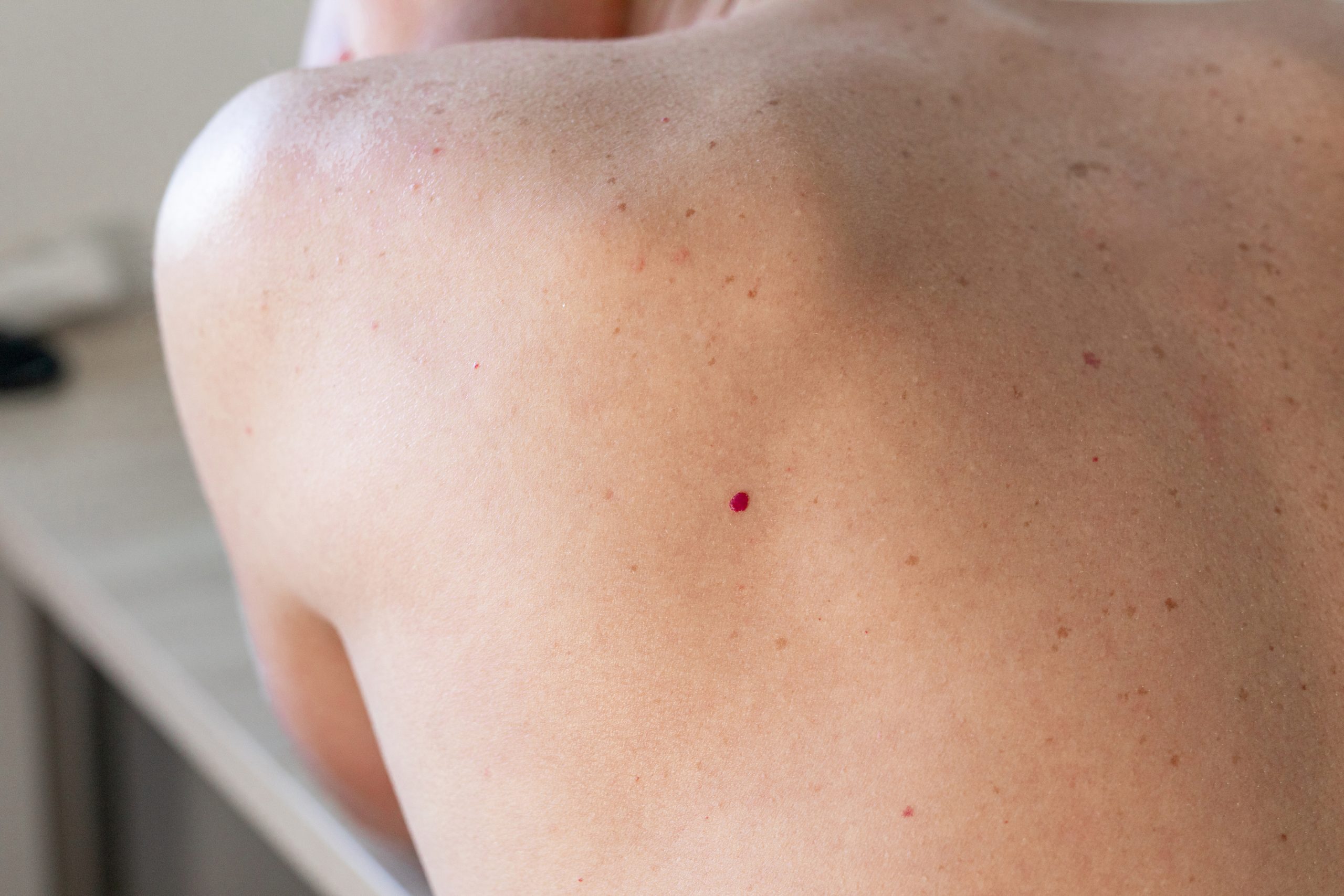 what-causes-red-moles-on-skin-and-how-to-get-rid-of-them-health-care