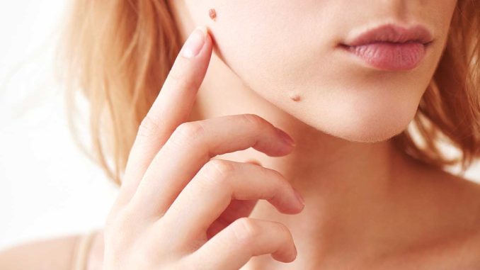 If You Have A Mole At One Of These Places On Your Body This Is What It Means Health Care